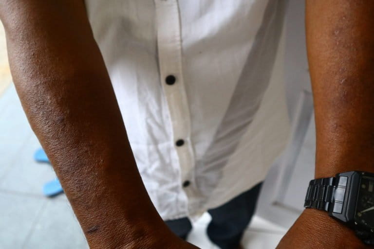 Seorang warga yang terkena gatal-gatal dan mulai mengering. Foto: Jaka HB/ Mongabay Indonesia