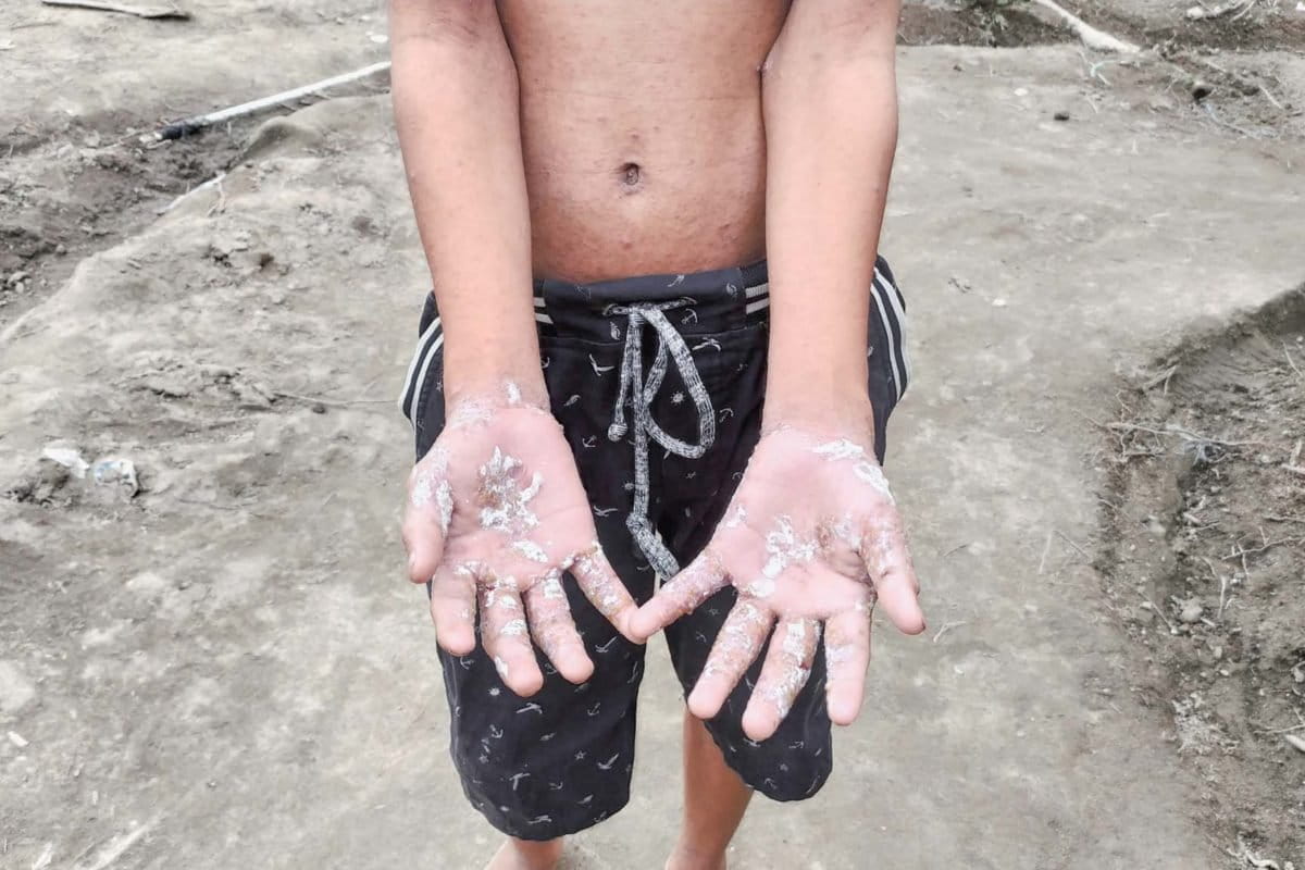 Hengki menunjukkan luka gatalnya - Agus Mawan.jpg